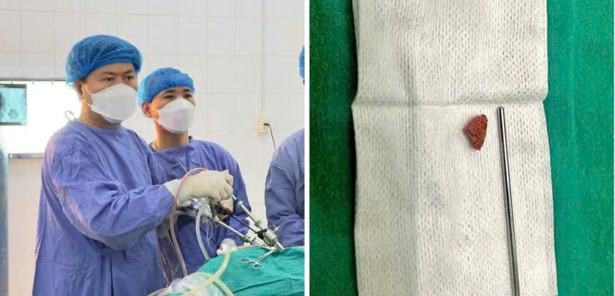 Hình ảnh tin tức Phẫu thuật nội soi sau phúc mạc lấy sỏi niệu quản tại Trung tâm y tế khu vực Yên Bái