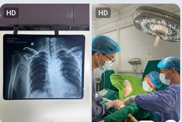 Hình ảnh tin tức Rút phương tiện kết hợp xương – những điều bạn cần biết